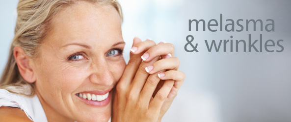 melasma & wrinkles